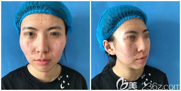 面診泰州麗都醫(yī)生設計術前脂肪填充方案 面診泰州麗都醫(yī)生設計術前脂肪填充方案