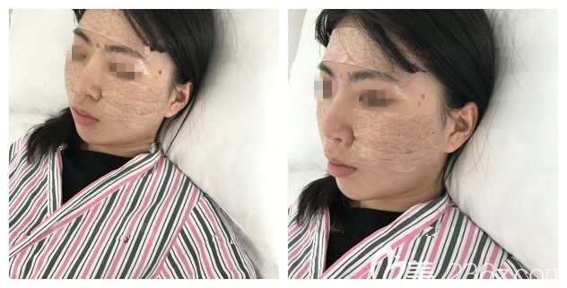 剛做完自體脂肪填充術后即刻效果 剛做完自體脂肪填充術后即刻效果