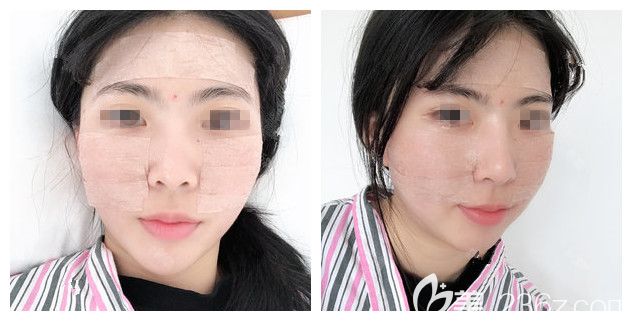 自體脂肪填充面部術后三天恢復 自體脂肪填充面部術后三天恢復