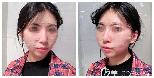 泰州做自體脂肪填充多少錢?看過麗都的價格后我去填充了60ml純脂肪目前術(shù)后恢復一周了