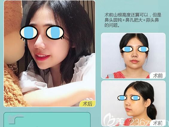 南寧華美整形胡凱鼻綜合隆鼻案例