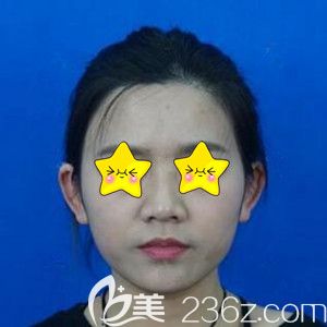 在美之峰做鼻綜合術前照 在美之峰做鼻綜合術前照