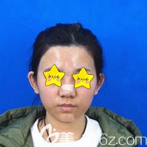 在長沙美之峰做鼻綜合術后1天照 在長沙美之峰做鼻綜合術后1天照