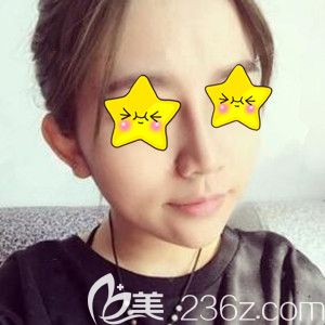在美之峰做鼻綜合術后15天恢復效果圖 在美之峰做鼻綜合術后15天恢復效果圖