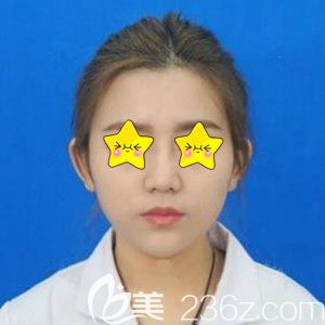 在長沙美之峰做鼻綜合整形術后30天效果 在長沙美之峰做鼻綜合整形術后30天效果
