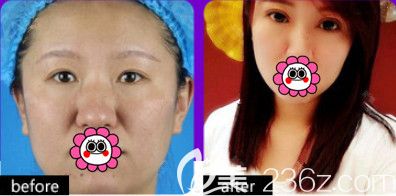 石家莊天伊美雙眼皮案例