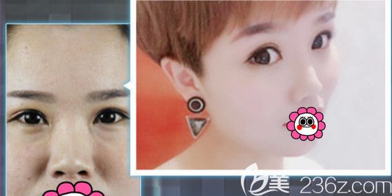 天伊美整形隆鼻手術(shù)案例