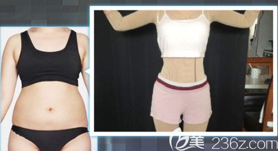 石家莊天伊美腰腹吸脂案例