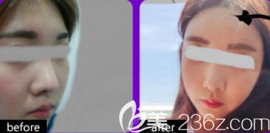 天伊美整形注射除皺案例