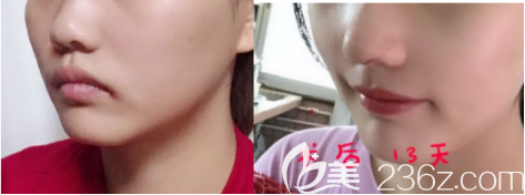 日照醫(yī)療美容醫(yī)院隆鼻案例一 日照醫(yī)療美容醫(yī)院隆鼻案例一