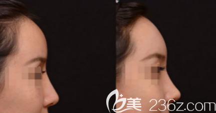 日照醫(yī)療美容醫(yī)院隆鼻案例二 日照醫(yī)療美容醫(yī)院隆鼻案例二