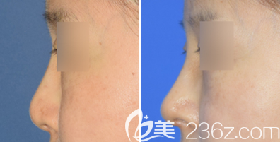 日照醫(yī)療美容醫(yī)院隆鼻案例三 日照醫(yī)療美容醫(yī)院隆鼻案例三