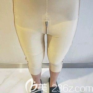 天伊美整形醫(yī)生張柏松為我做大腿吸脂術(shù)后腿部腫脹 天伊美整形醫(yī)生張柏松為我做大腿吸脂術(shù)后腿部腫脹