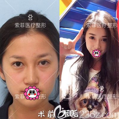 哈爾濱索菲陳富全鼻修復(fù)案例