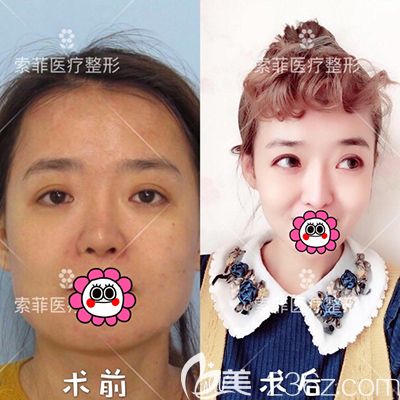 哈爾濱索菲隆鼻真人案例對比效果