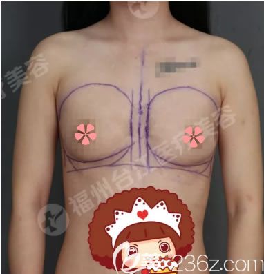 在福州臺(tái)江整形做曼托假體隆胸術(shù)前照耀 在福州臺(tái)江整形做曼托假體隆胸術(shù)前照耀