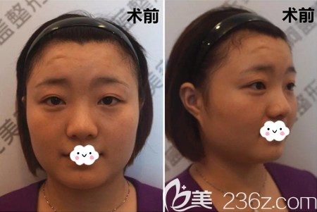 天天鼻綜合術(shù)前照片
