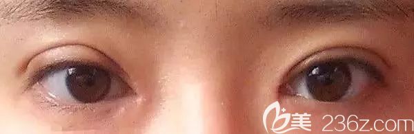 雙眼皮弧度不自然