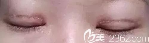 雙眼皮切口疤痕明顯