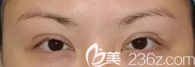 雙眼皮術(shù)后睜眼費(fèi)力