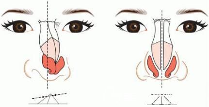 隆鼻塑鼻尖應該選擇那些材料