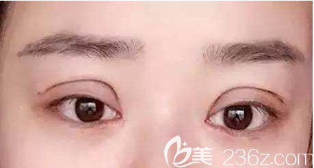 雙眼皮割太深（雙眼皮過(guò)寬）