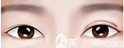 雙眼皮不對(duì)稱