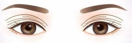 多層雙眼皮