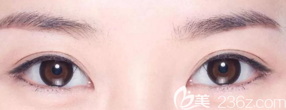 雙眼皮過(guò)窄