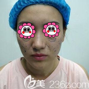 做埋線提升玻尿酸填充面部術(shù)前照 做埋線提升玻尿酸填充面部術(shù)前照