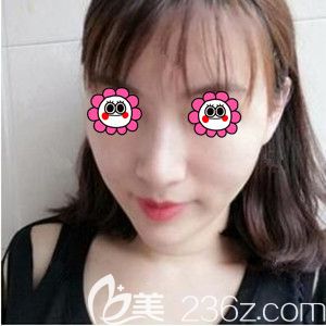 在長沙臉博士做面部提升術(shù)后3天照 在長沙臉博士做面部提升術(shù)后3天照