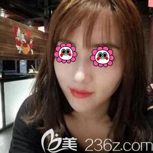 在長沙做面部埋線提升與玻尿酸填充術(shù)后半個月效果圖 在長沙做面部埋線提升與玻尿酸填充術(shù)后半個月效果圖