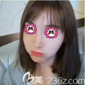 在長沙臉博士做面部年輕化手術(shù)術(shù)后40天效果圖 在長沙臉博士做面部年輕化手術(shù)術(shù)后40天效果圖