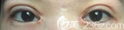 雙眼皮疤痕增生