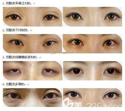 雙眼皮失敗修復(fù)前后對(duì)比圖