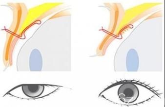 矯正上瞼下垂手術(shù)示意圖
