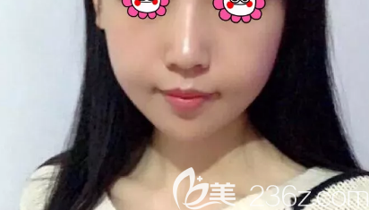 日照醫(yī)療美容醫(yī)院做自體脂肪填充手術(shù)挺厲害的，不信的話請看我的日記