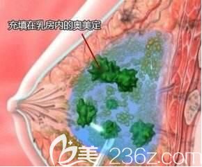 奧美定豐胸摸起來什么感覺呢?必須取出嗎？