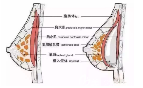 假體隆胸示意圖