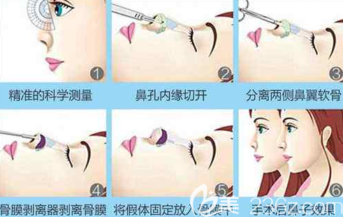 假體隆鼻示意圖 假體隆鼻示意圖