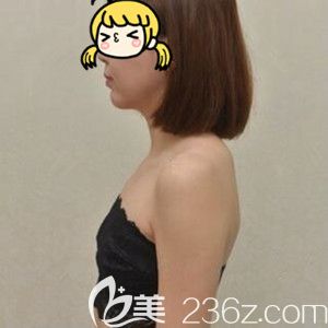 在海南做假體隆胸術(shù)前照 在海南做假體隆胸術(shù)前照