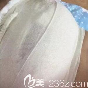 假體隆胸術(shù)后1天照 假體隆胸術(shù)后1天照