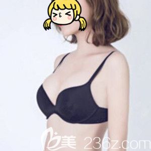 做進(jìn)口曼托假體豐胸術(shù)后20天效果圖 做進(jìn)口曼托假體豐胸術(shù)后20天效果圖