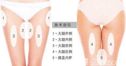 大腿吸脂的幾個部位