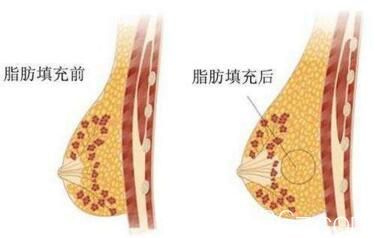 自體脂肪豐胸價(jià)格貴嗎？多少錢？