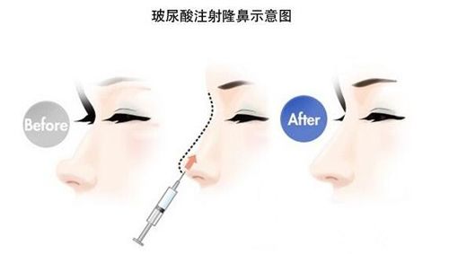玻尿酸隆鼻整形手術(shù)步驟原理圖