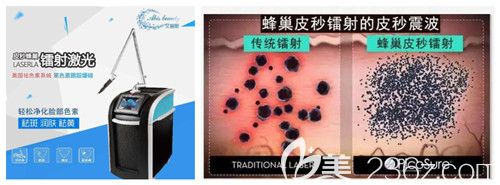 皮秒祛除黃褐斑過程