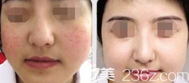 面部去紅血絲案例對比圖