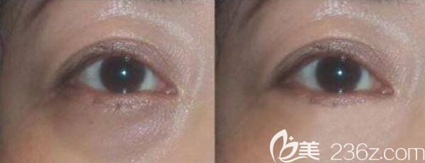 楊繼紅做激光去除黑眼圈的案例效果對比圖