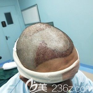 <!--<i data=20240703-sp></i>-->主任幫我做發(fā)際線種植術(shù)后即刻